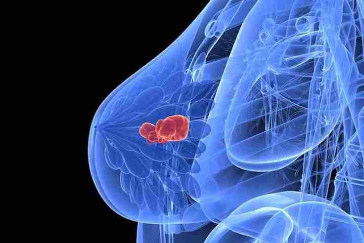    TUMORI: CRO, PREMIATA IN TEXAS RICERCA SU CARCINOMA MAMMARIO 